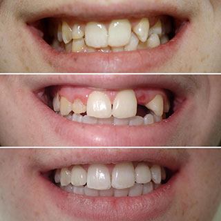 dental implants before and after
