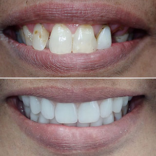 dental implants before and after