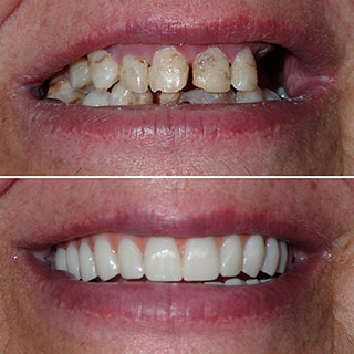 teeth in a day toronto
