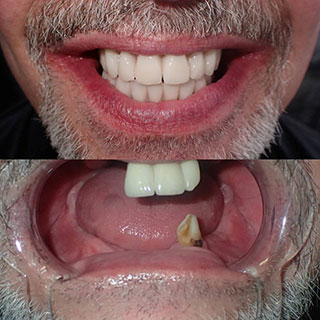 teeth in a day toronto