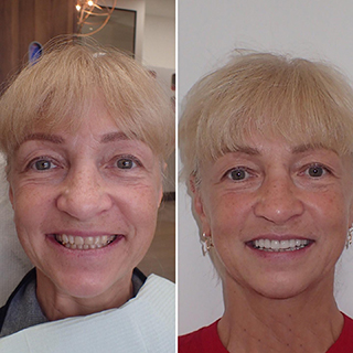 dental implants before and after