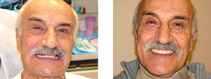 Before and after All-on-Four dental implants results at All on Four Dental Implants