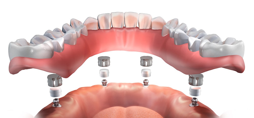 What is All-on-4 Procedure?