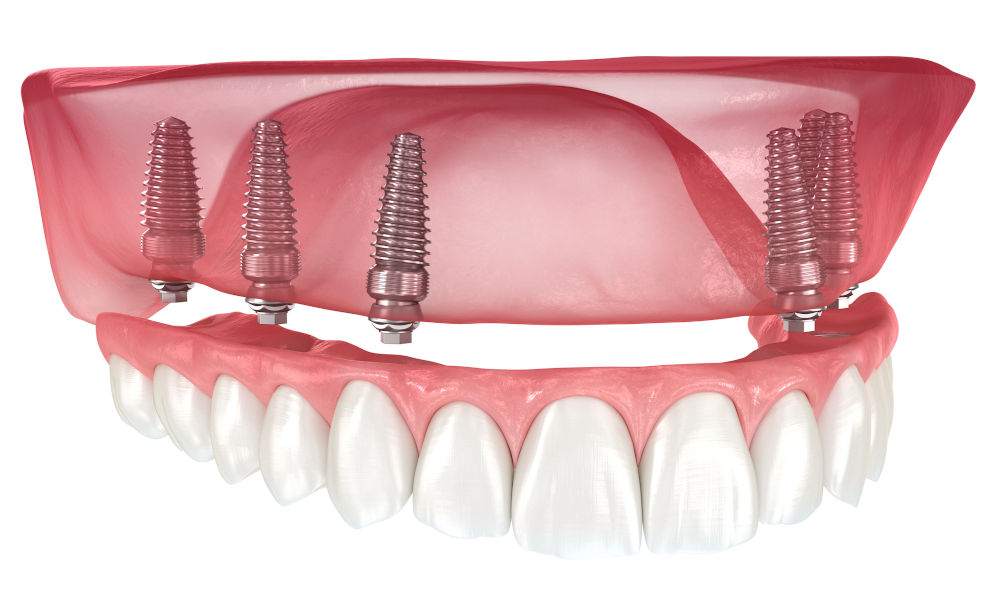 Anatomical dental model demonstrating how four implants support a full arch prosthesis in the jaw