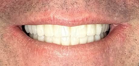 Patient smile after All-on-4 dental implant treatment at Smile Centre