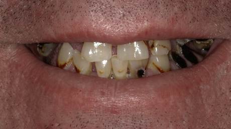 Patient's natural teeth before All-on-4 dental implant treatment at Smile Centre